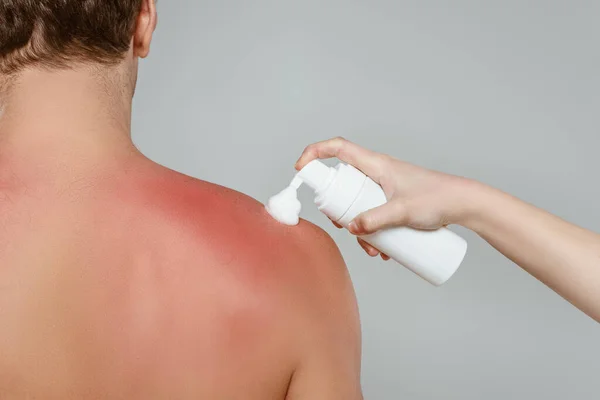 Vista recortada de la mujer aplicando espuma en la espalda masculina con quemaduras solares aisladas en gris - foto de stock