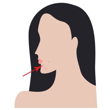 Sivilceli kadın yüzü - vektör. Sağlık hizmetleri. Prosedür tıbbi. Güzellik salonu.