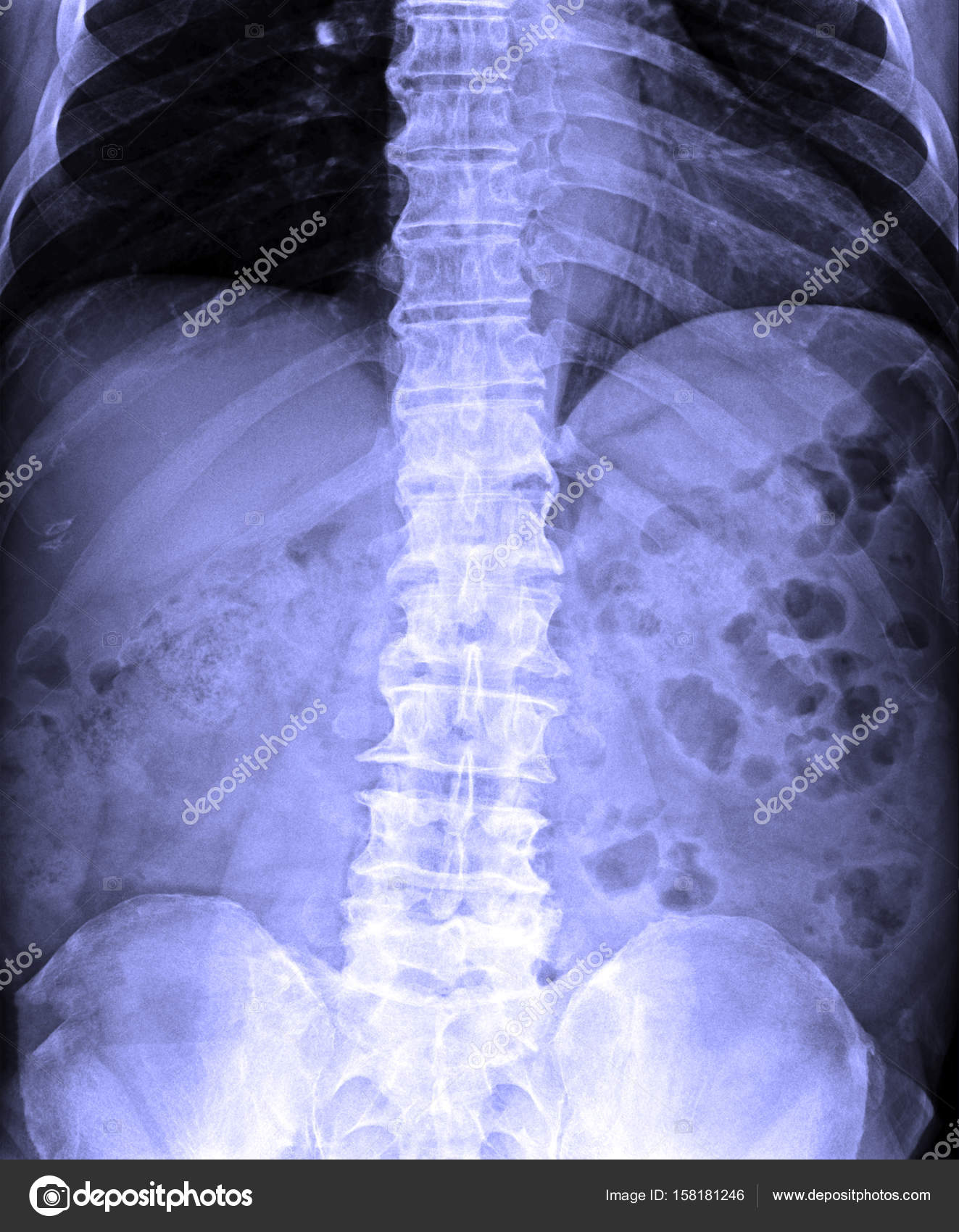 X Ray Image Of Human T L Spine Ap Lat Stock Photo Image By C V74 X Ray Image Of Human T L Spine Ap Lat Stock Photo Image By C V74
