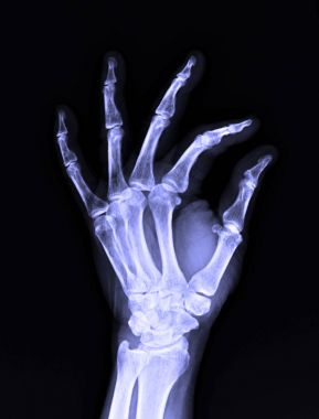 Erkek insan sol el X-Ray görüntüsü 