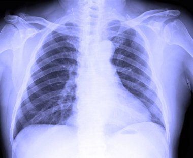 Erkek insan göğüs X-Ray görüntüsü