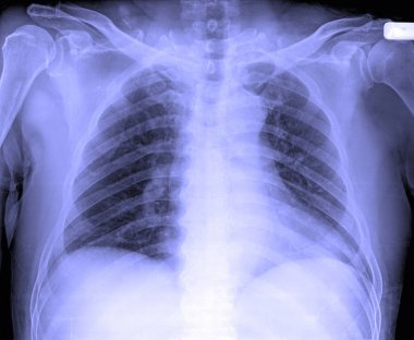 Erkek insan göğüs X-Ray görüntüsü