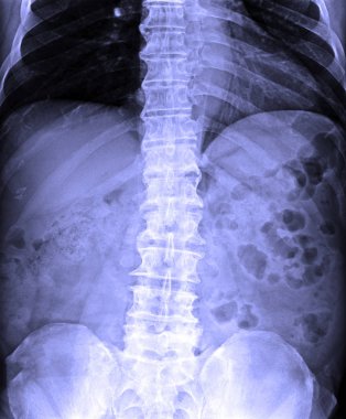 X-Ray görüntü insan T-L omurga Ap/Lat