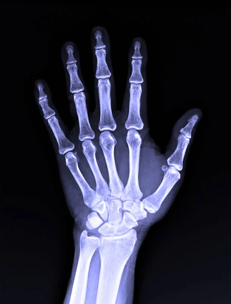 X-Ray image of male human hand — Stock Photo, Image