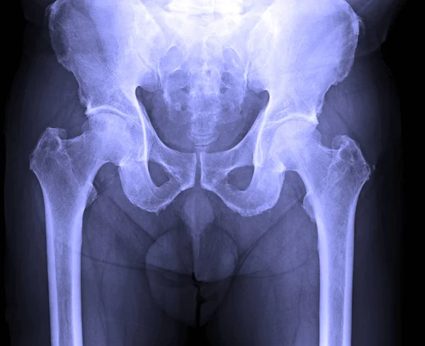 Röntgenbild der männlichen menschlichen Wirbelsäule, Risse, Becken — Stockfoto