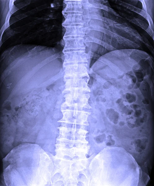 X-Ray görüntü insan T-L omurga Ap/Lat — Stok fotoğraf