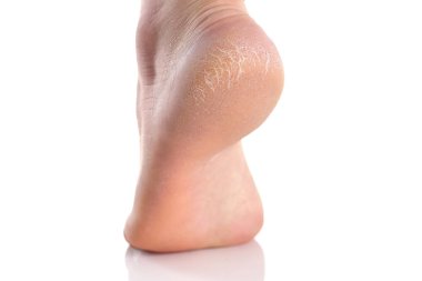 Kötü cilt ayak topuk çatlakları ile kaplıdır