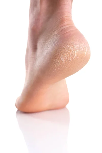 Il tallone del piede con la pelle cattiva è coperto di crepe — Foto Stock