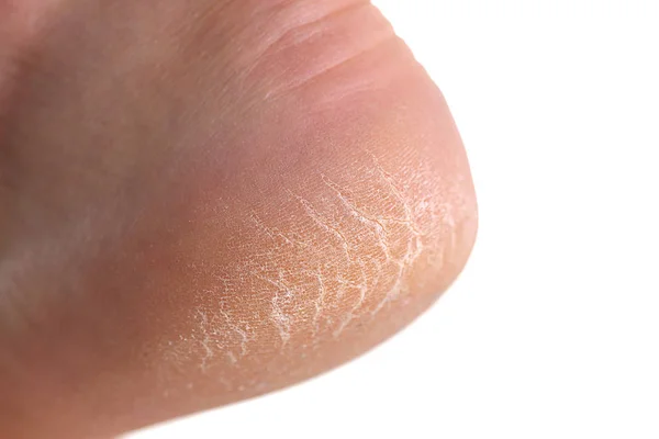 El talón del pie con mala piel está cubierto de grietas —  Fotos de Stock