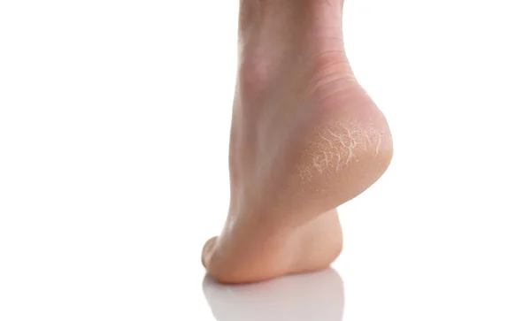 A sarok-láb rossz bőrrel borított repedések — Stock Fotó
