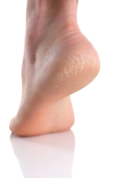 Pięty stóp z zły skóry pokryte pęknięcia — Zdjęcie stockowe