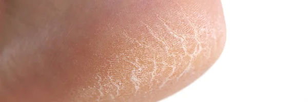 The heel of foot with bad skin covered with cracks — Stock Photo, Image