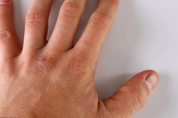 Skadad manliga arm med skadade torr hud — Stockfoto