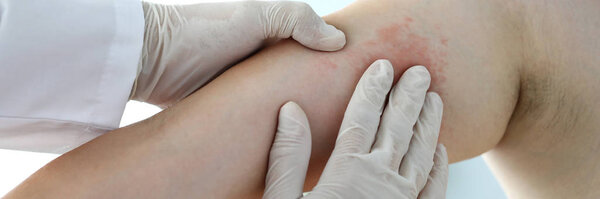 Allergic rush on epidermis