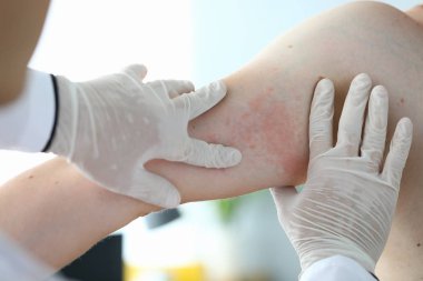 Close-up examination by doctor, allergic rash.