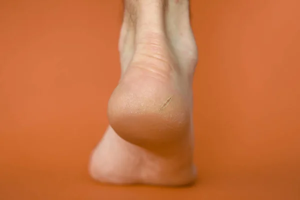 Primo piano parte inferiore piede maschile, tallone con crepa . — Foto Stock