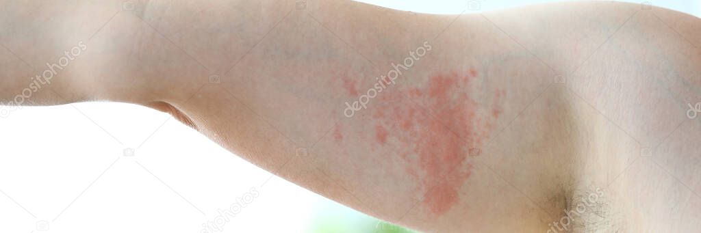Painful allergic rush
