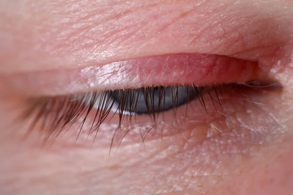 Ragad az emberi szem közelkép bőrbetegség — Stock Fotó
