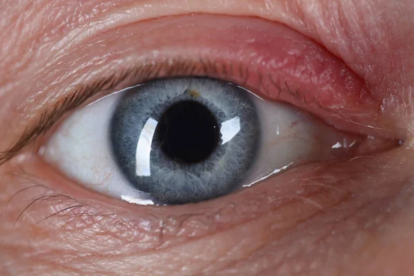Sty on human eye closeup skin disease — Stock Photo, Image