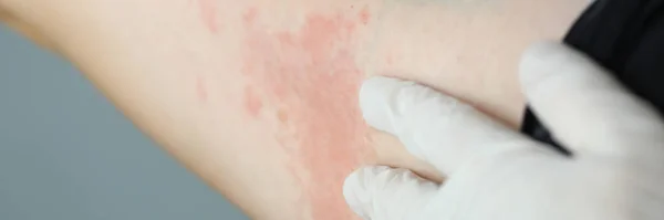 Close-up red rash on white skin hand, examination — Stock Photo, Image