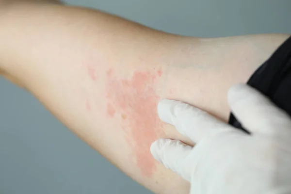 Close-up red rash on white skin hand, examination — Stok Foto