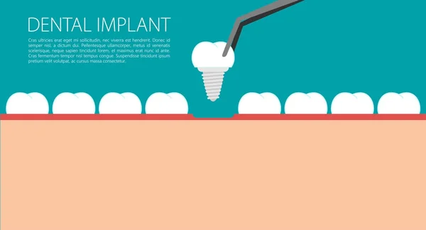 Dental implant flat background — Stock Vector