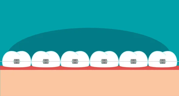 Denti bretelle immagine piatta — Vettoriale Stock