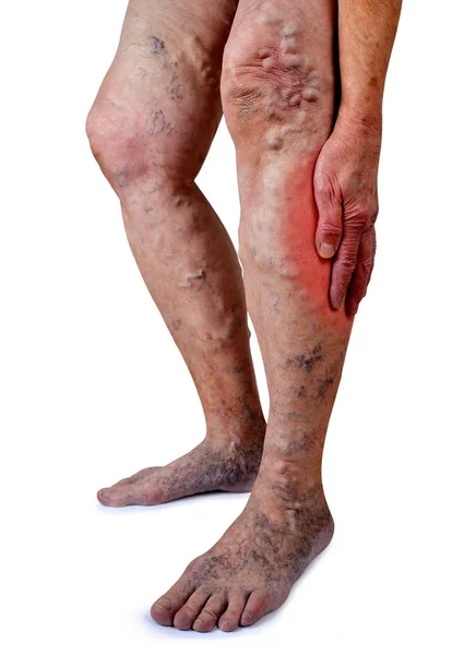 The varicose veins on a legs of old woman — Stock Photo, Image