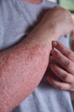 Sedef hastası bir kadının ön kol görüntüsü.