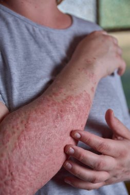 Sedef hastası bir kadının ön kol görüntüsü.