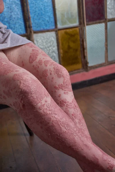 Vista Del Ginocchio Della Gamba Della Donna Con Psoriasi — Foto Stock