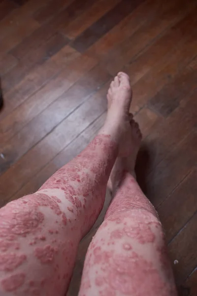 乾癬を持つ女性の足と足のビュー — ストック写真
