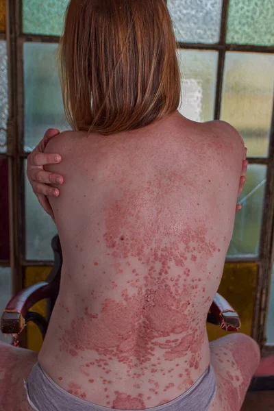 Schienale Donna Con Psoriasi Seduta Una Sedia — Foto Stock