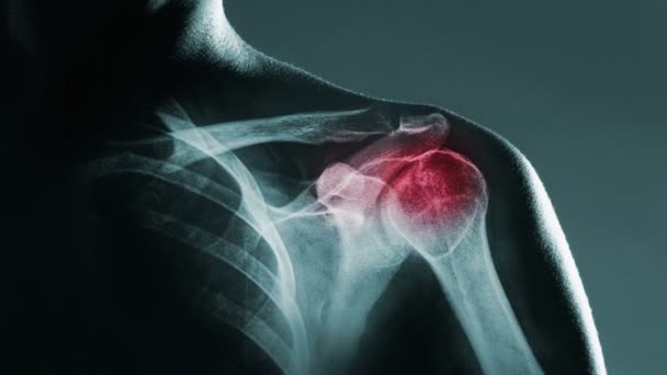 Human shoulder joint in x-ray — Stock Video