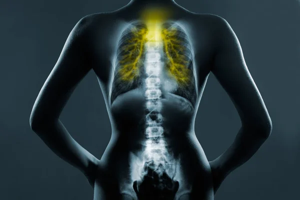 Röntgenfilm der Lungen mit dem Virus Covid-19, Lungenentzündung, Tuberkulose. — Stockfoto