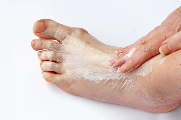 A woman rubs her foot with a pain ointment. A woman spreads cream on her foot