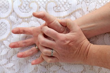 Güçlü eller yaşlılar titreyerek. Parkinson hastalığı olan bir kadının ellerini sallayarak vardır