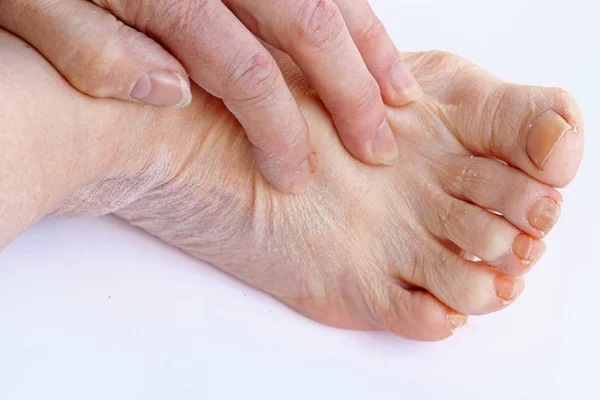 Yaşlı Bir Kadının Elleri Ayakları Kuru Kaşıntılı Cilt Vardır — Stok fotoğraf