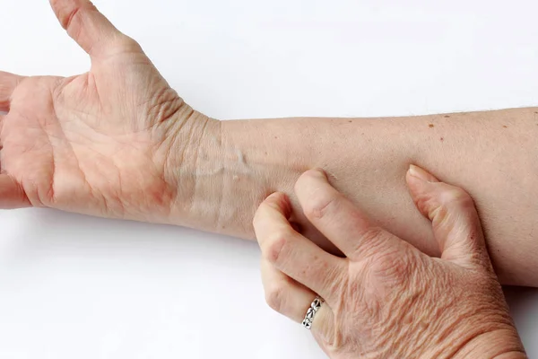 一个女人在她的手臂的内侧有干燥发痒的皮肤 — 图库照片