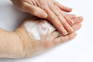 Bir kadın ellerini acı merhemiyle ovuyor. Kuru cilde karşı el kremi