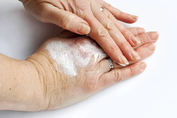 Μια Γυναίκα Τρίβει Χέρια Της Μια Αλοιφή Πόνου Κρέμα Χεριών — Φωτογραφία Αρχείου