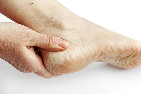 Callus Dry Skin Woman Feet Cornea Heel — Stock Photo, Image