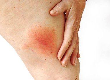 Bir kene tarafından iletilen bir kadının bacak floş Lyme borreliosis göçebe. Lyme hastalığı kene ısırması uylukta neden.