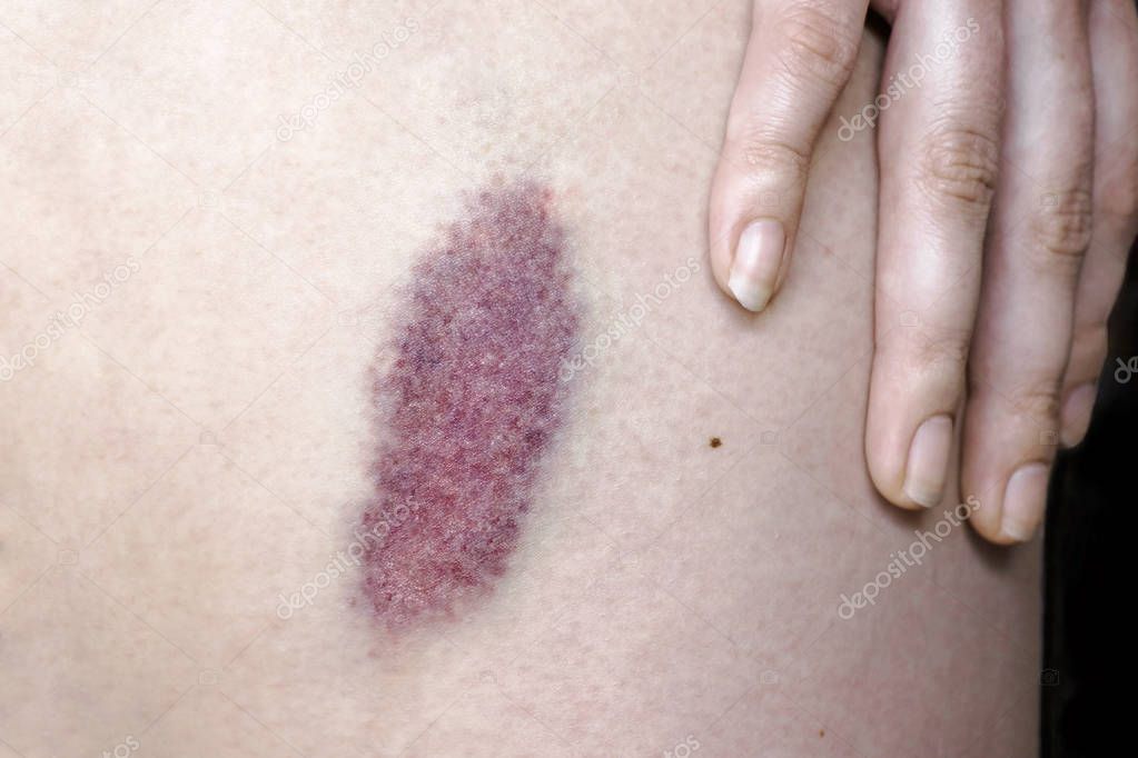 A hematoma on a woman's leg. A large bruise on the skin of a human