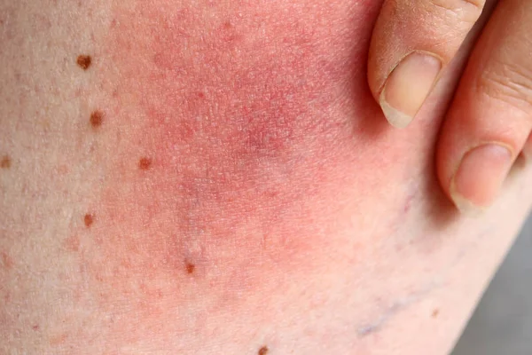 在一个女人的腿上有虱子携带的莱姆血友病脸红 因过敏引起的腿部皮肤红肿 — 图库照片