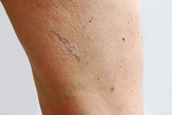 Spinaderen Spataderen Cellulitis Het Been Van Een Vrouw — Stockfoto