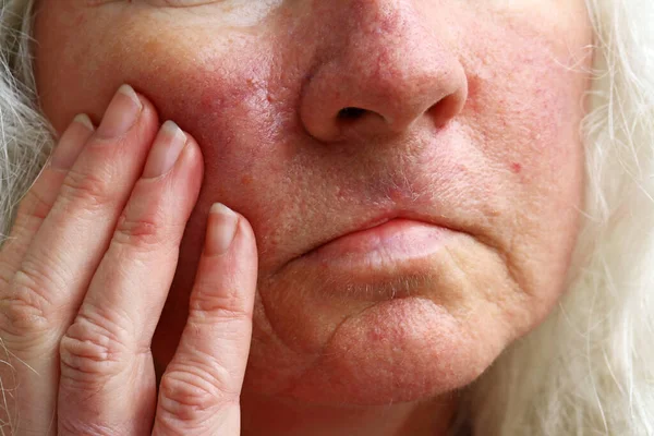Yaşlı Bir Kadının Yüzünde Kırmızı Damarlar Lekeler Ameliyat Izleri Var — Stok fotoğraf