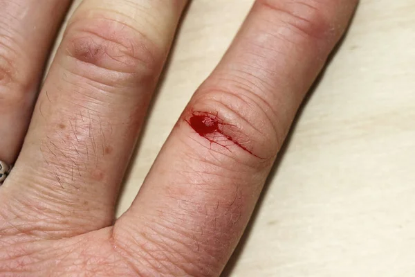 A bleeding injury on a woman\'s finger. A bleeding wound on the hand