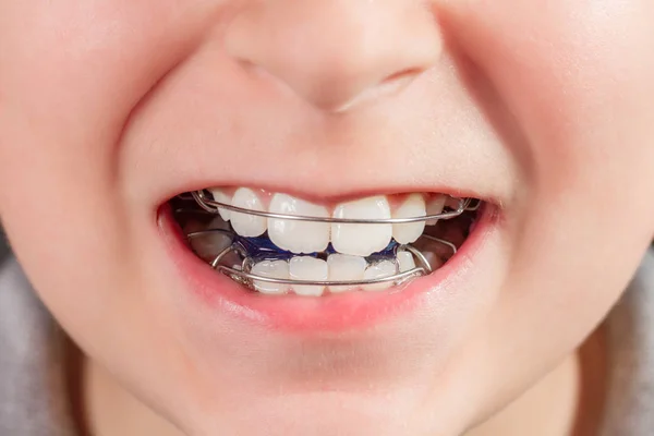 Child with orthodontic appliance close-up — Stock Photo, Image
