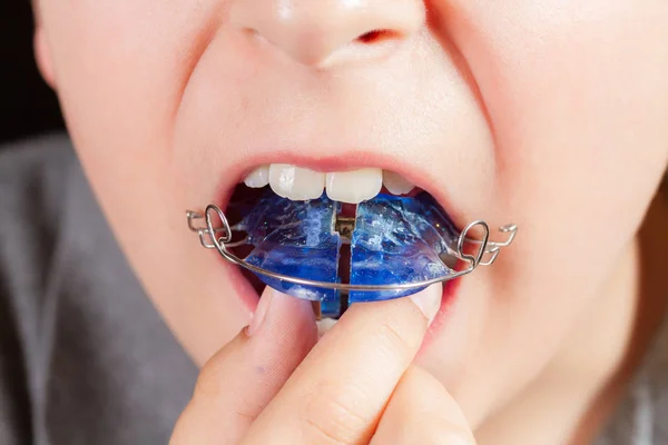 Ребенок с ортодонтическим прибором крупным планом — стоковое фото